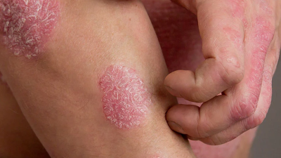 Psoriasis: Symptoms and Causes