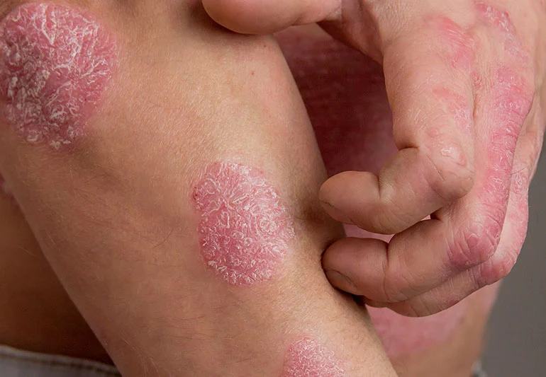 Psoriasis: Symptoms and Causes