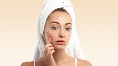 Achieving Clear Skin: Effective Acne Treatments Explained